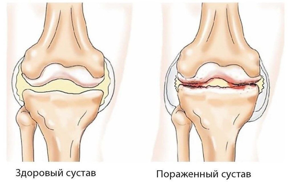 Наиболее яркая картина синовита с частыми обострениями наблюдается при остеоартрозе