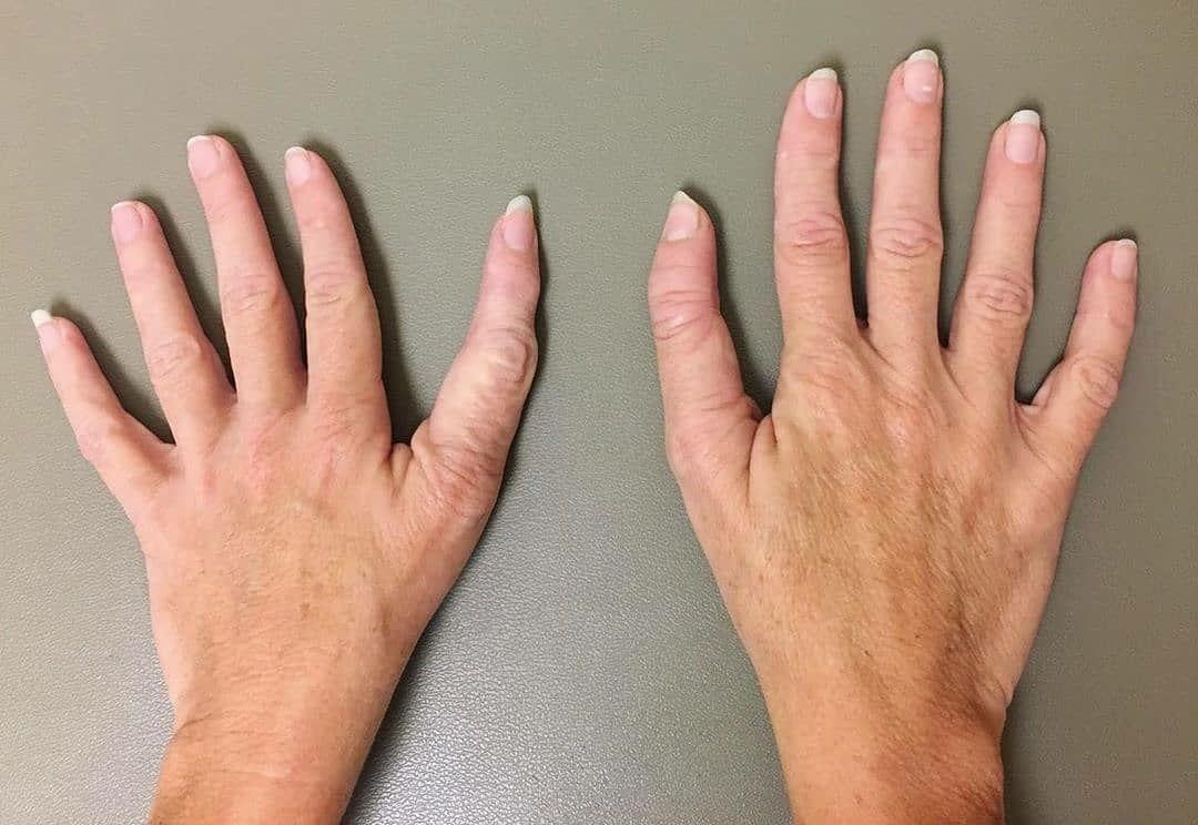 Двухваланговые пальцых