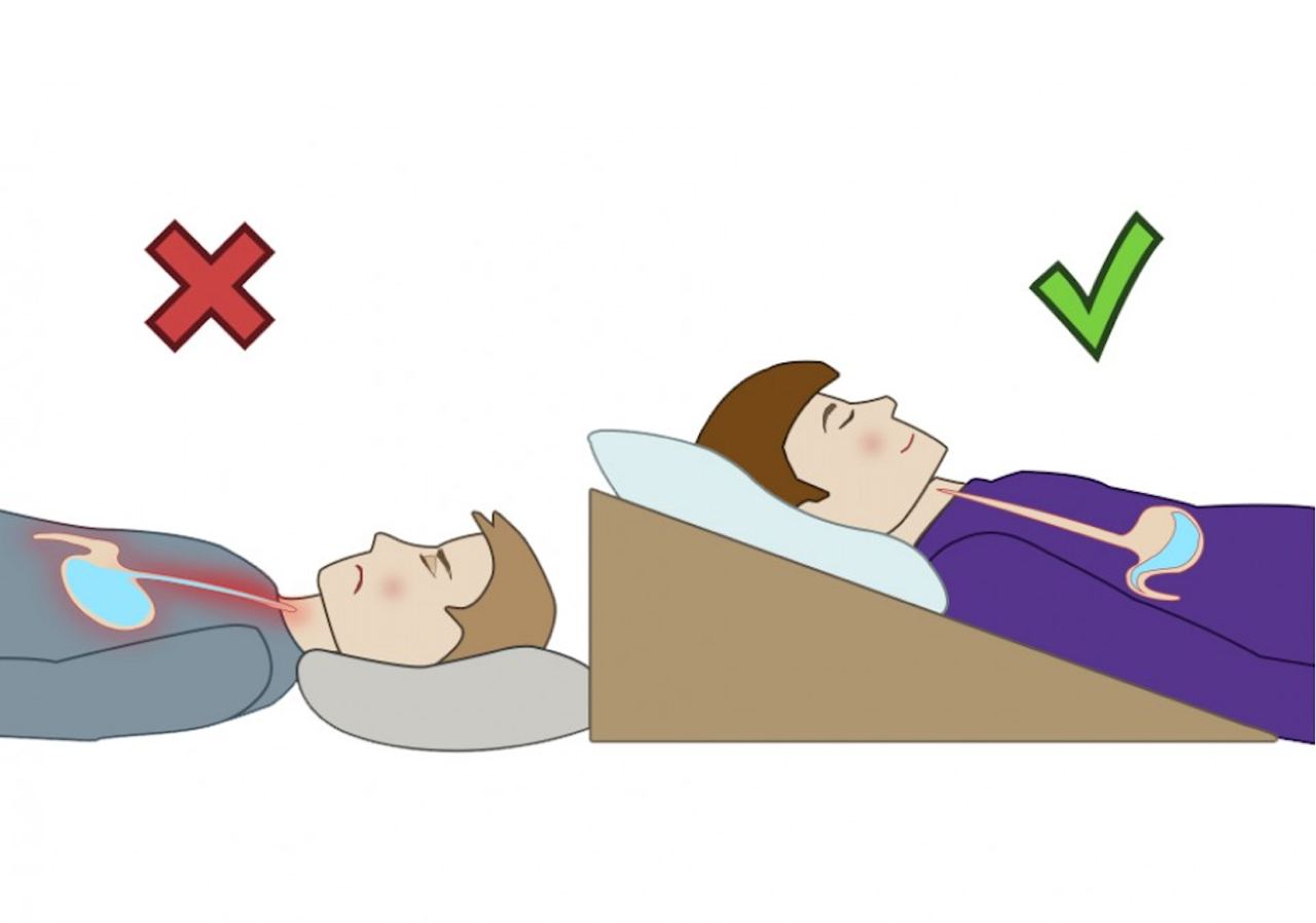После операции нельзя спать. Клиновидная подушка ГЭРБ. Клиновидная подушка для сна при ГЭРБ. Подушка при ГЭРБ. Подушка при рефлюкс эзофагите.
