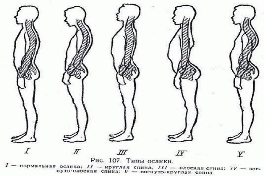 Рассмотрите рисунки 1 4 на каком из них изображен подросток с нормальной осанкой